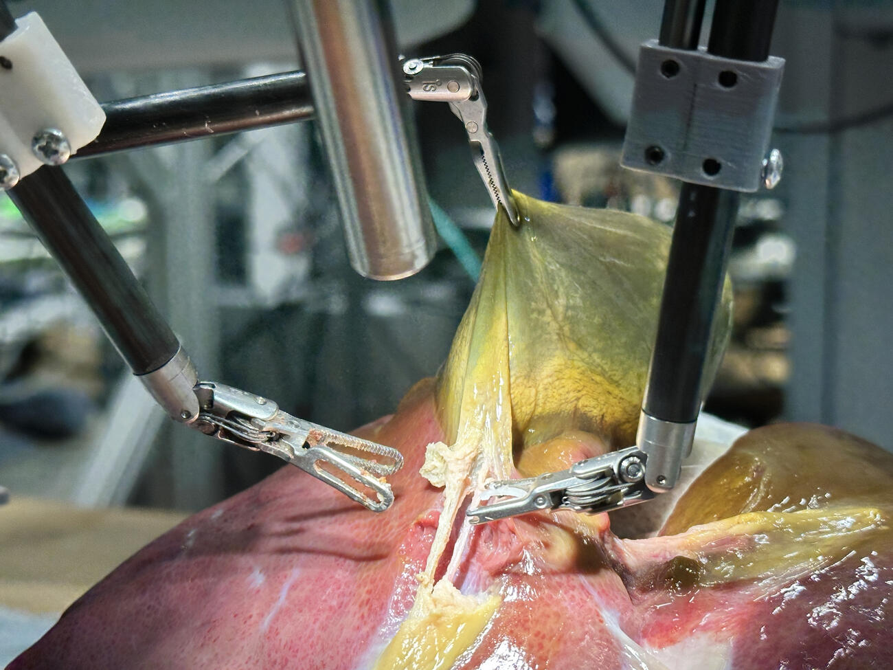 Inside the First Fully Autonomous Robotic Surgery — What It Means for the Future of Medicine